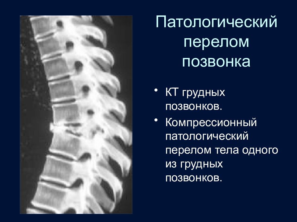 Компрессионный перелом позвоночника кт. Компрессионный перелом грудного позвонка рентген. Патологический компрессионный перелом th9 позвонка. Компрессионные переломы тел позвонков на кт. Патологический перелом тела th1 позвонка.