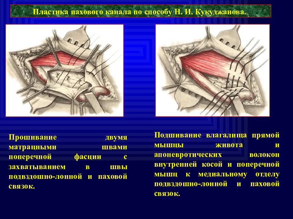 Схема пластики пахового канала