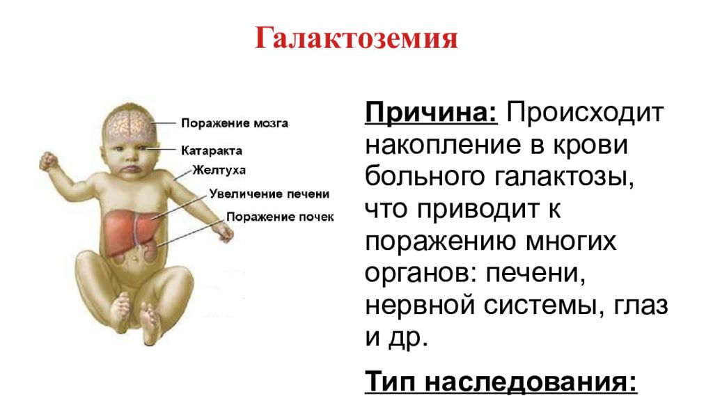 Галактоземия признаки заболевания. Галактоземия презентация. Галактоземия Тип мутации презентация.