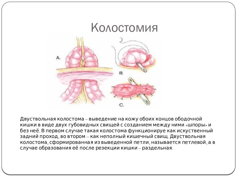Как выглядит стома после операции СЗГМУ им.И.И.Мечникова Кафедра оперативной хирургии и топографической анатомии -