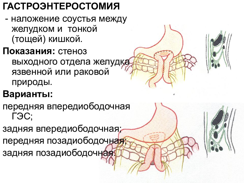 Анастомоз по брауну схема