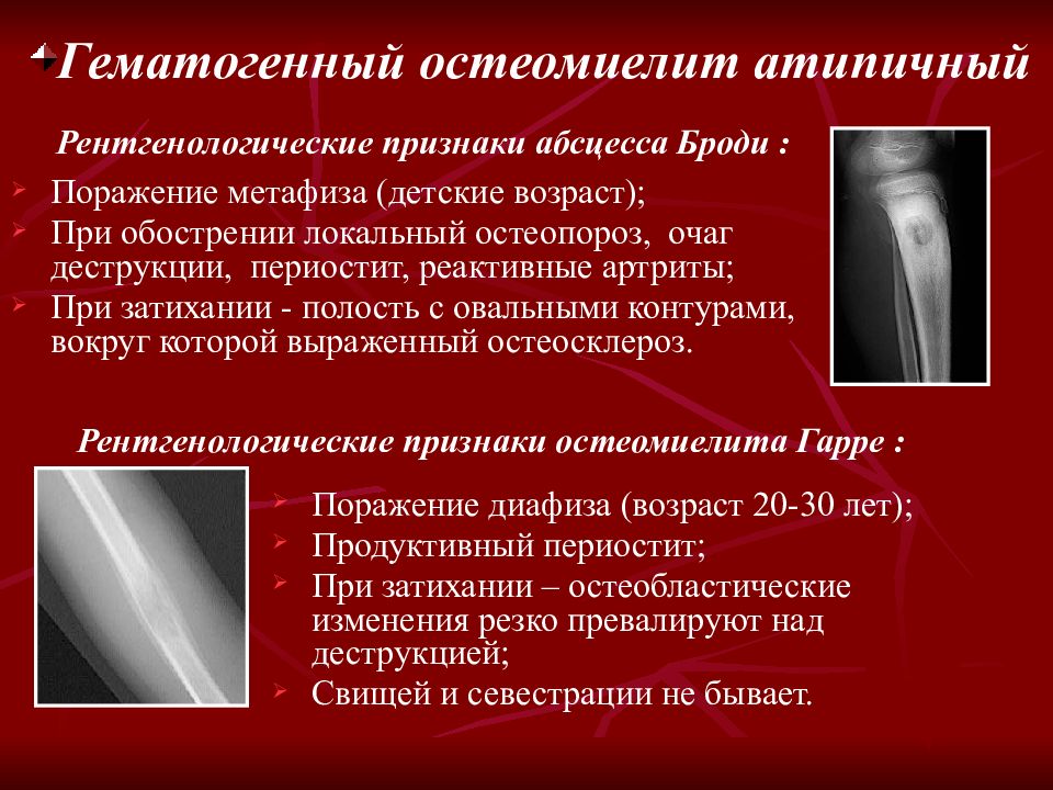 Гематогенный. Хронический гематогенный остеомиелит рентген. Рентгенологические признаки гематогенного остеомиелита. Первично хронический остеомиелит рентген. Симптомы острого гематогенного остеомиелита.