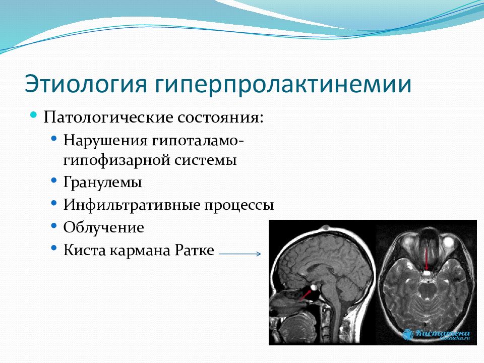 Презентация на тему гиперпролактинемия