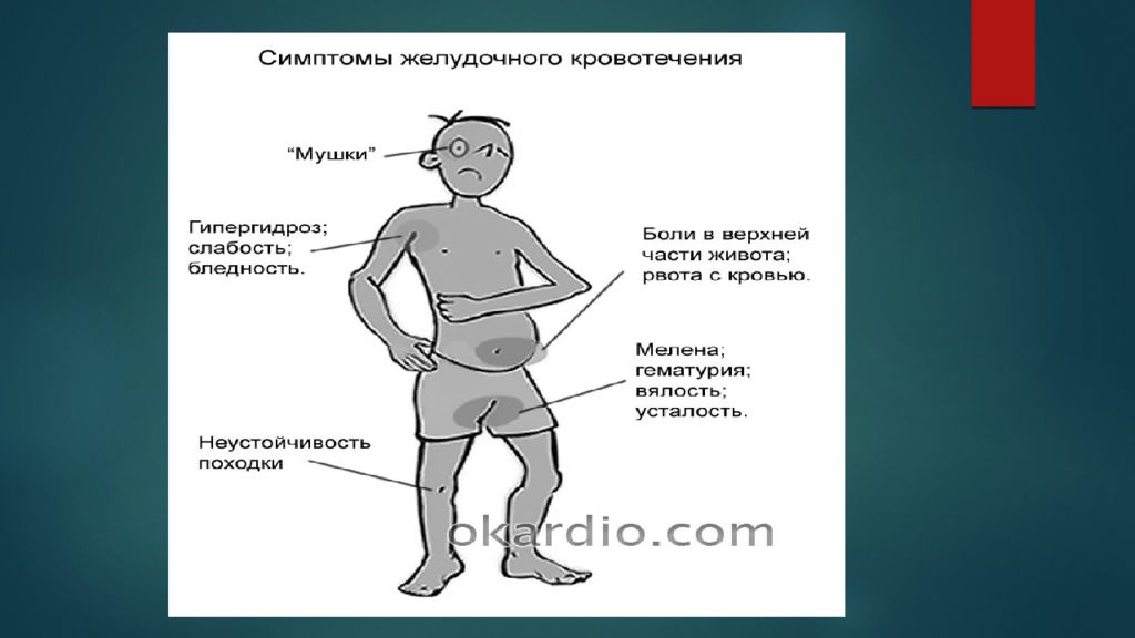 Желудочное кровотечение симптомы. Признаки желудочного кровотечения. Основные признаки желудочного кровотечения. Основные симптомы желудочного кровотечения.