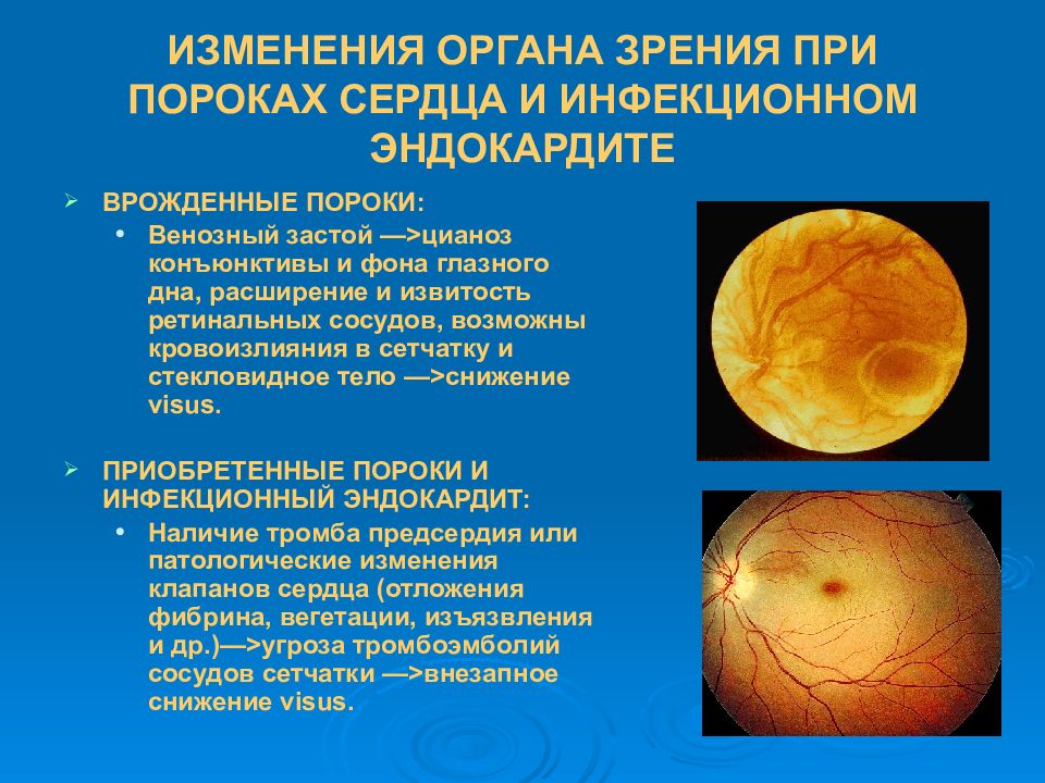 Изменение органов. Изменения органа зрения при общих заболеваниях. Глазное дно при инфекционном эндокардите. Изменения глазного дна при заболеваниях. Глазное дно при врожденных пороках сердца.