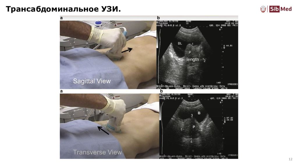 Простаты трансабдоминально. УЗИ обзорное (трансабдоминально). Трансабдоминальное УЗИ предстательной железы. УЗИ предстательной железы трансабдоминально. Трансабдоминальное УЗИ это у мужчин.