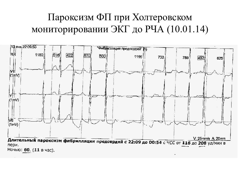 Пароксизмальная форма фп карта вызова