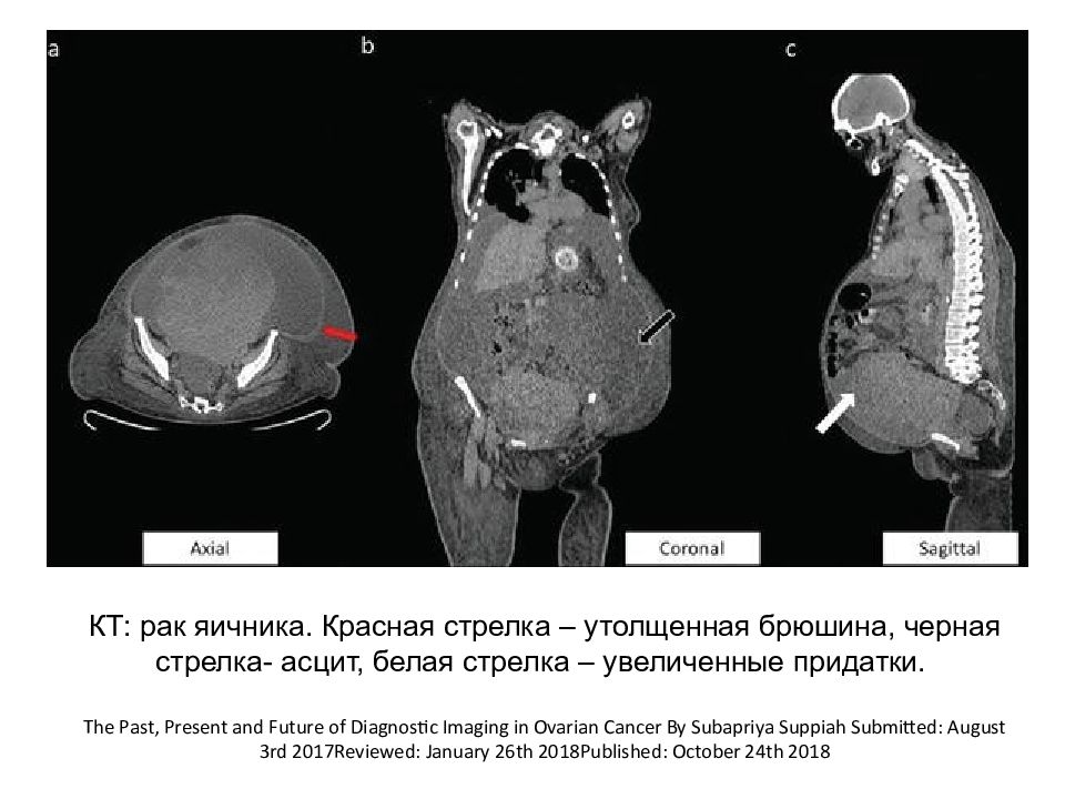 Рак яичников картинки