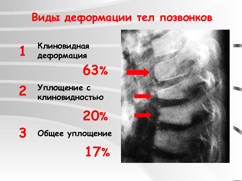 Деформация позвонков. Клиновидная деформация тела th6. Клиновидная деформация th7 позвонка. Умеренная передняя клиновидная деформация тела th12, l1. Клиновидная деформация тел l2, l3 позвоночника.