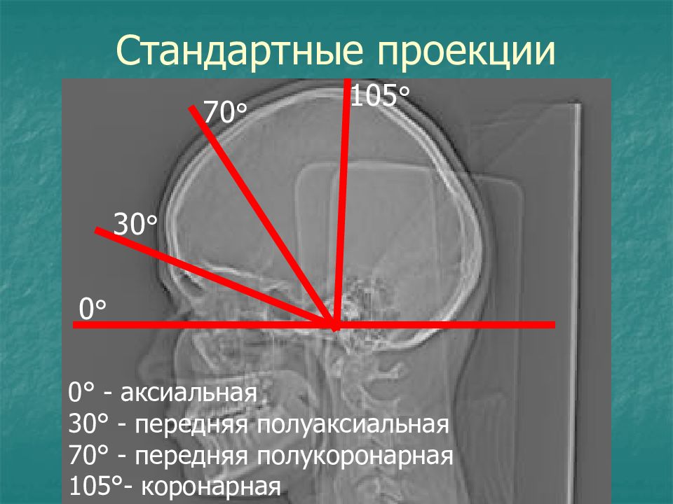 Аксиальная проекция. Аксиальная проекция кт. Аксиальная проекция рентген. Рентгенография черепа в аксиальной проекции.