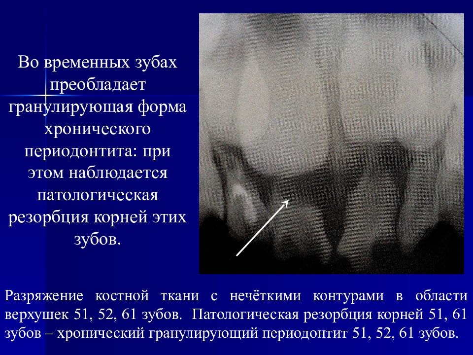 Для рентгенологической картины фолликулярной кисты характерна деструкция костной ткани