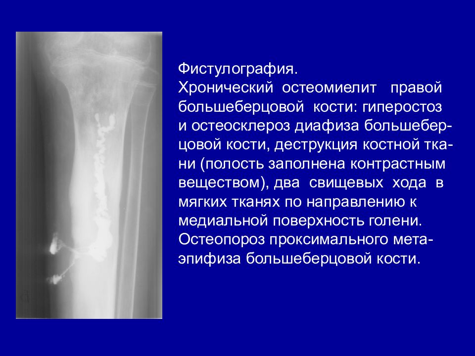 Для рентгенологической картины фолликулярной кисты характерна деструкция костной ткани