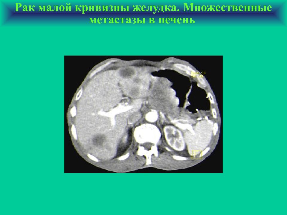 Метастазы желудка. Множественные метастазы в печени. Кт при метастазах желудка.