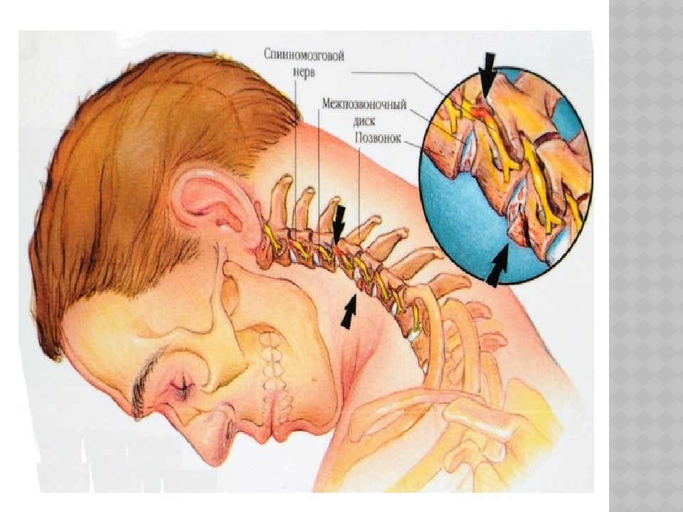 Защемление нерва в шейном отделе