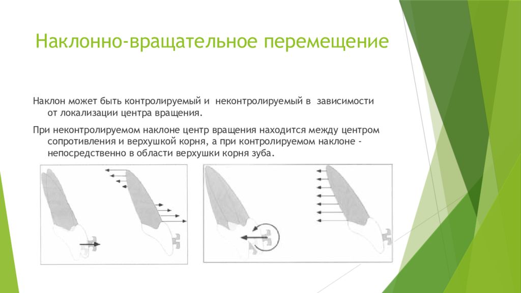 Виды перемещений. Наклонно вращательное перемещение зуба. Контролируемый наклон зуба. Неконтролируемый наклон зуба. Виды перемещения зубов.