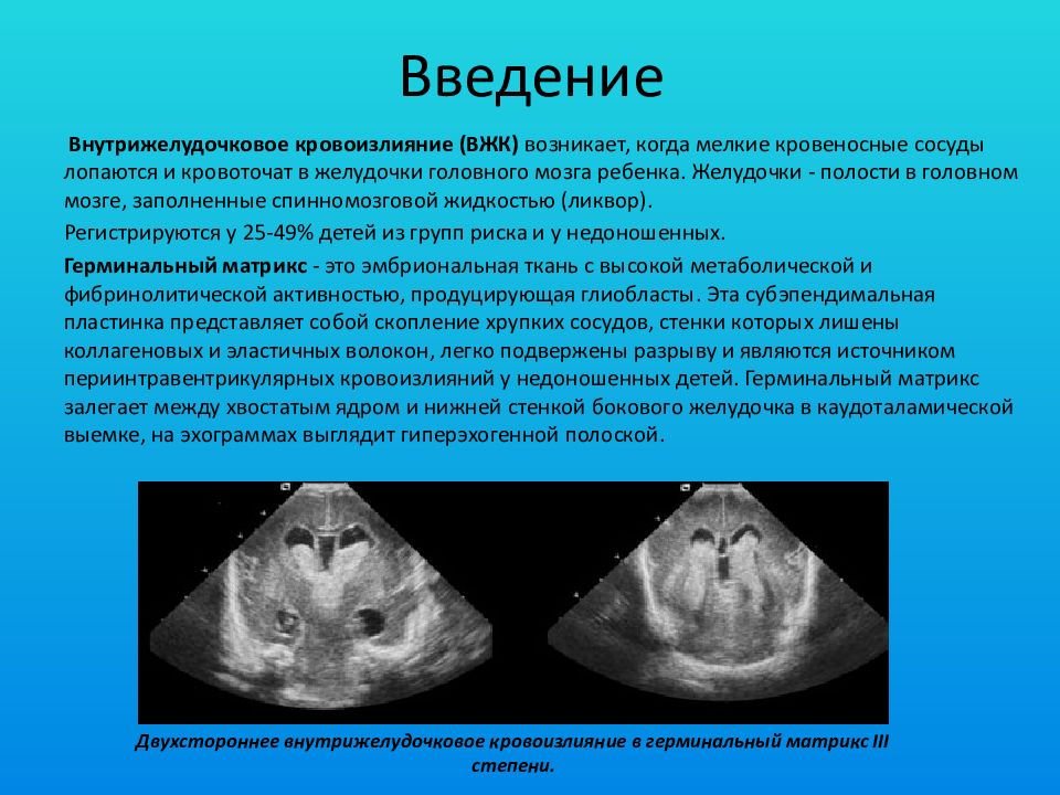 Кровоизлияние желудочка. Герминативный Матрикс. Внутрижелудочковое кровоизлияние нейросонография. Кровоизлияние в желудочки головного мозга. Вентрикулярные кровоизлияние мозга.