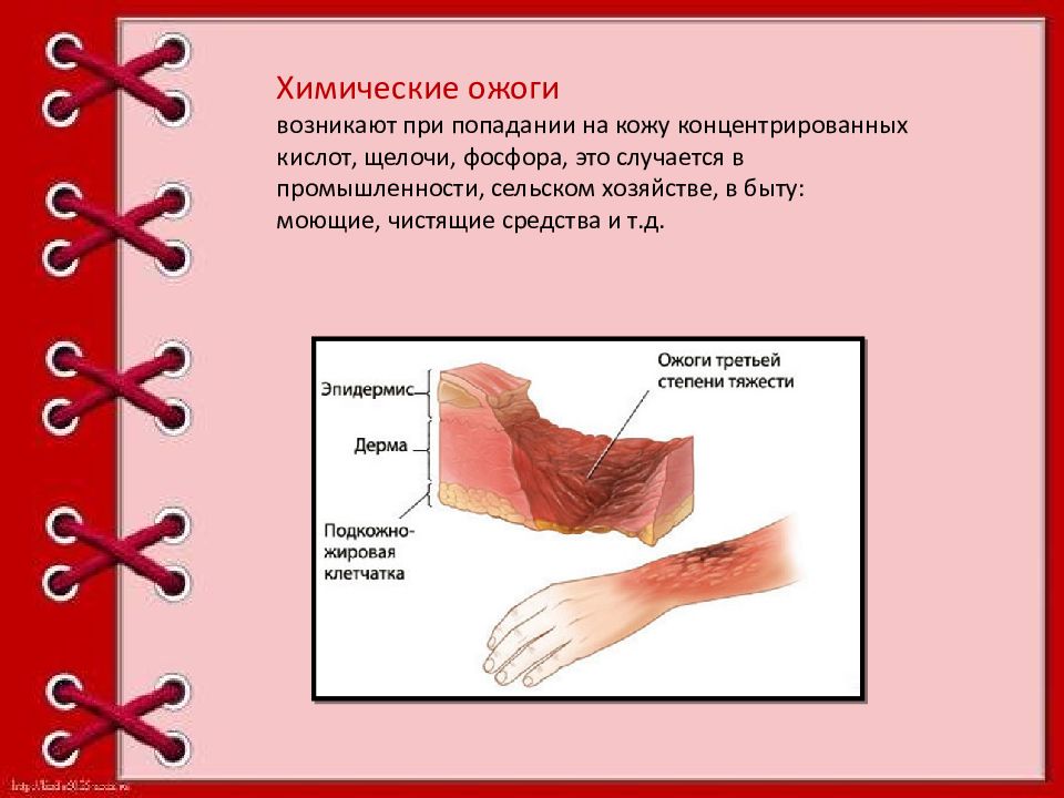 Химические травмы картинки