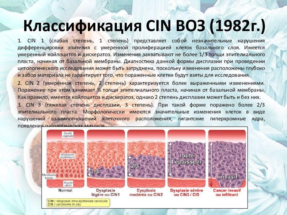 Дисплазия шейки матки степени. Дисплазия эпителия 3 степени. Cin 2 степени шейки матки.