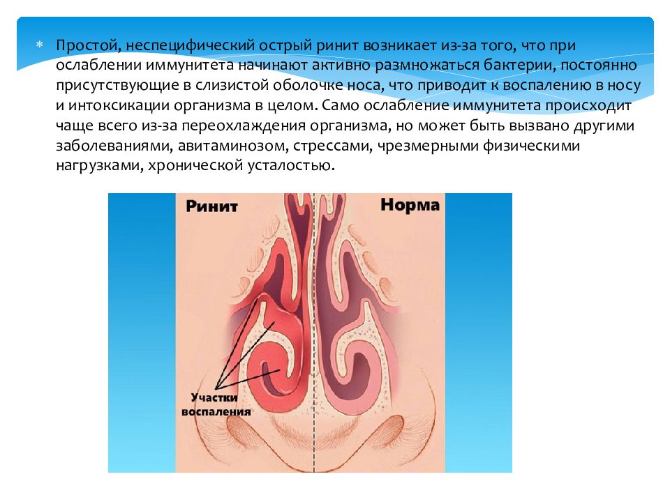 Острый ринит презентация у детей