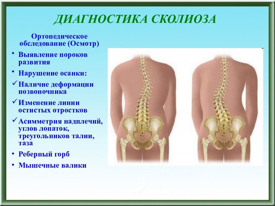 Диагноз позвоночника. Диагностика сколиоза. Диагностирование сколиоза.