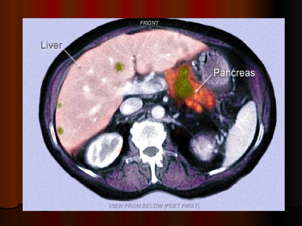 Пэт печени. ПЭТ кт поджелудочной железы. Ацинарноклеточная карцинома поджелудочной железы. Метастазы поджелудочной железы. Метастазы поджелудочной на кт.