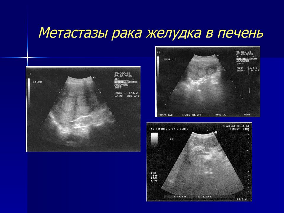 Рак желудка метастазы. Опухоль желудка метастазирование. Метастатические опухоли печени.