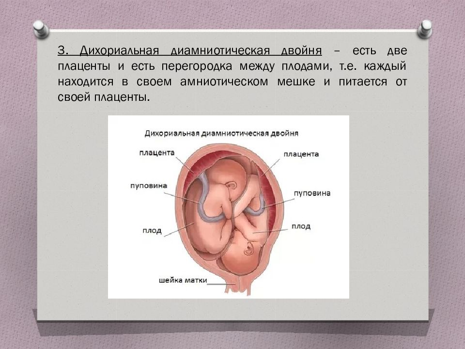 Ди ди беременности. Диамниотическая плацента. Диамниотическая беременность двойней. Дихориальная диамниотическая тройня. Дизориальная деамнеатическая двойня.