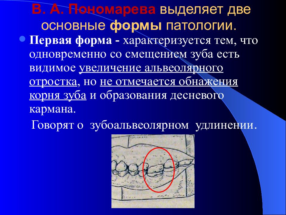 Классификация пономарева. Формы зубоальвеолярного удлинения по в.а Пономаревой. Зубоальвеолярное удлинение по Пономаревой. Зубоальвеолярное удлинение по Пономаревой классификация. Пономарева выделяет количество форм зубочелюстных деформаций.