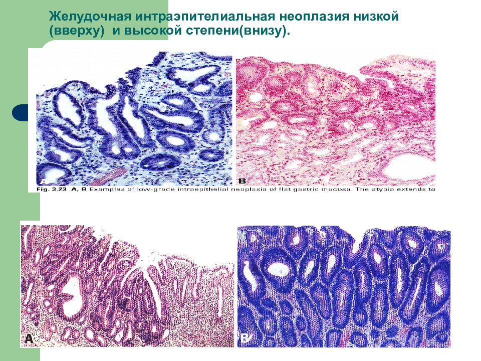 Аденома с интраэпителиальной неоплазией low grade. Тубуло-ворсинчатая аденома толстой кишки гистология. Интраэпителиальная неоплазия низкой степени. Интраэпителиальная неоплазия желудка. Интраэпителиальная неоплазия низкой степени толстой кишки.