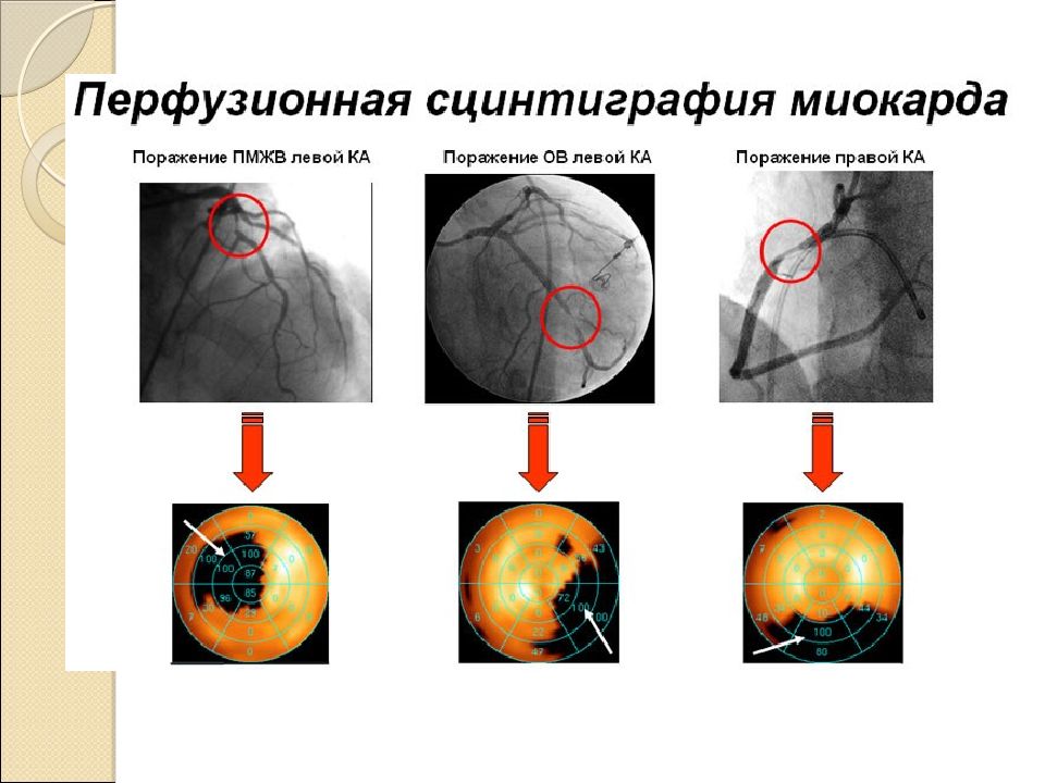 Презентация сцинтиграфия миокарда