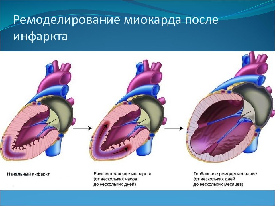 Инфаркт левого. Концентрический Тип ремоделирования миокарда. Ремоделирование миокарда по типу тоногенной дилатации. Клинико-лабораторные проявления ремоделирования миокарда. Ремоделирование левого желудочка при инфаркте миокарда.