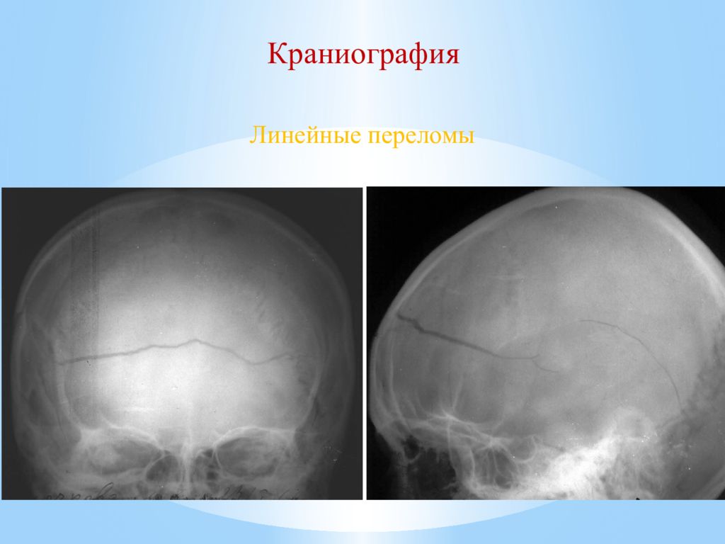 Сотрясение черепа. Линейный перелом теменной кости. Краниография линейный перелом.