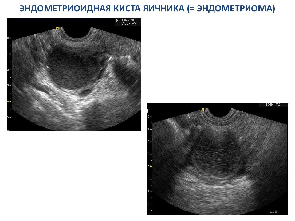 Киста яичника на узи. Эндометриоидная киста УЗИ картина. Энуклеация эндометриоидной кисты. Эндометриоидная киста яичника. Эндометриоидная киста на УЗИ ЦДК.