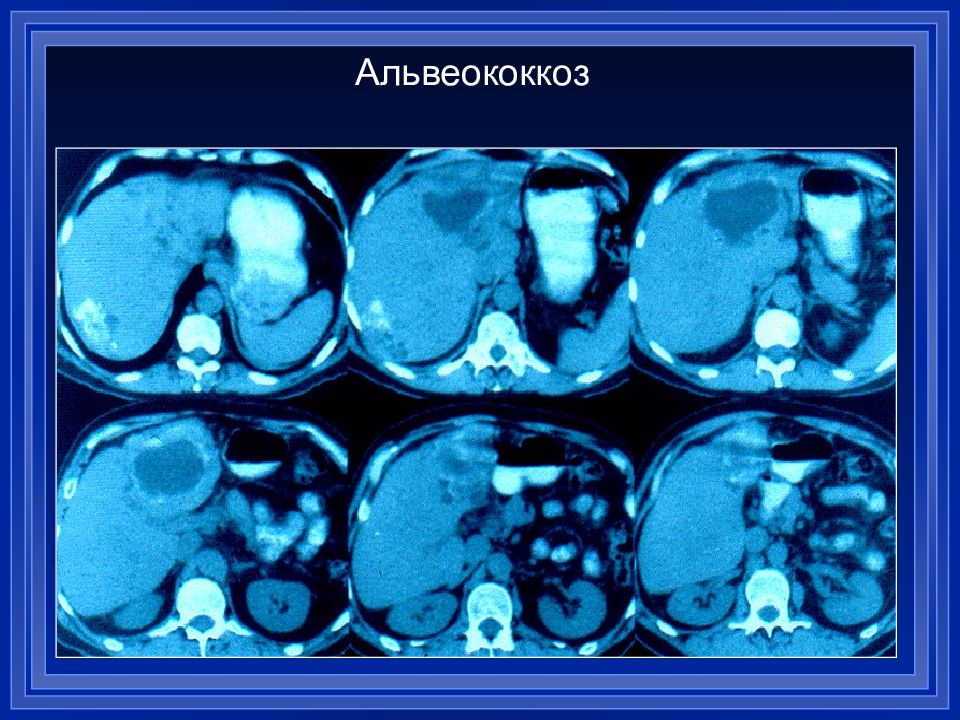 Альвеококкоз. Альвеококкоз печени кт. Альвеококкоз печени рентген. Альвеококкоз печени мрт. Эхинококкоз и альвеококкоз печени.