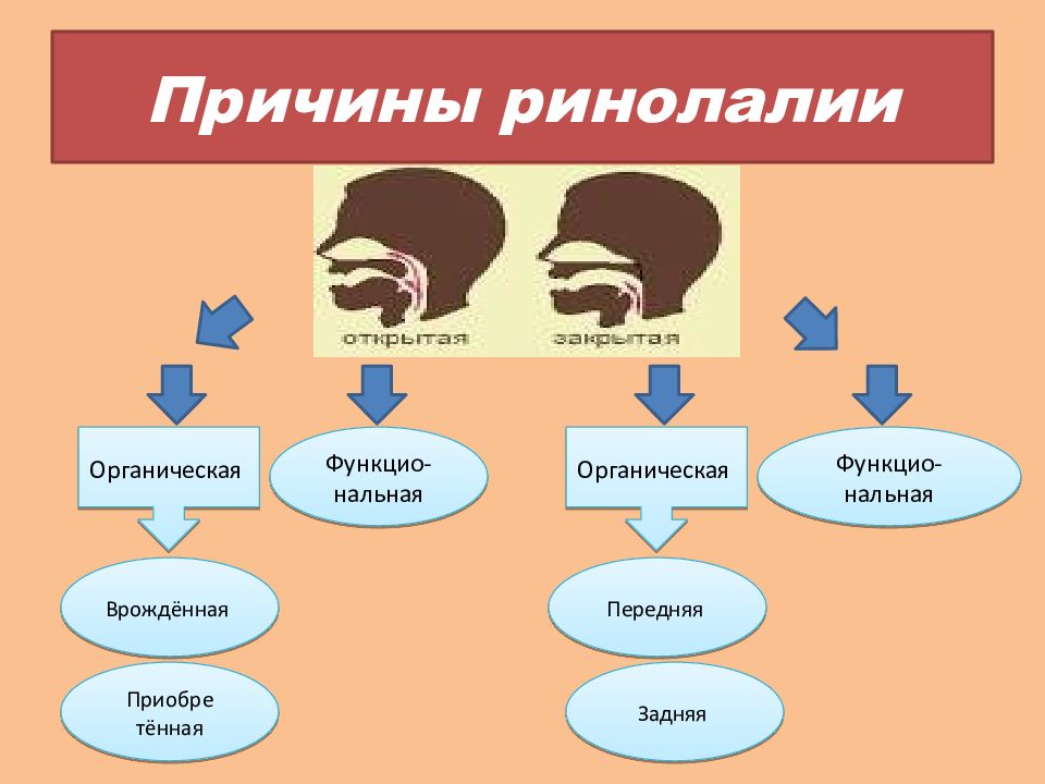 Классификация ринолалии схема