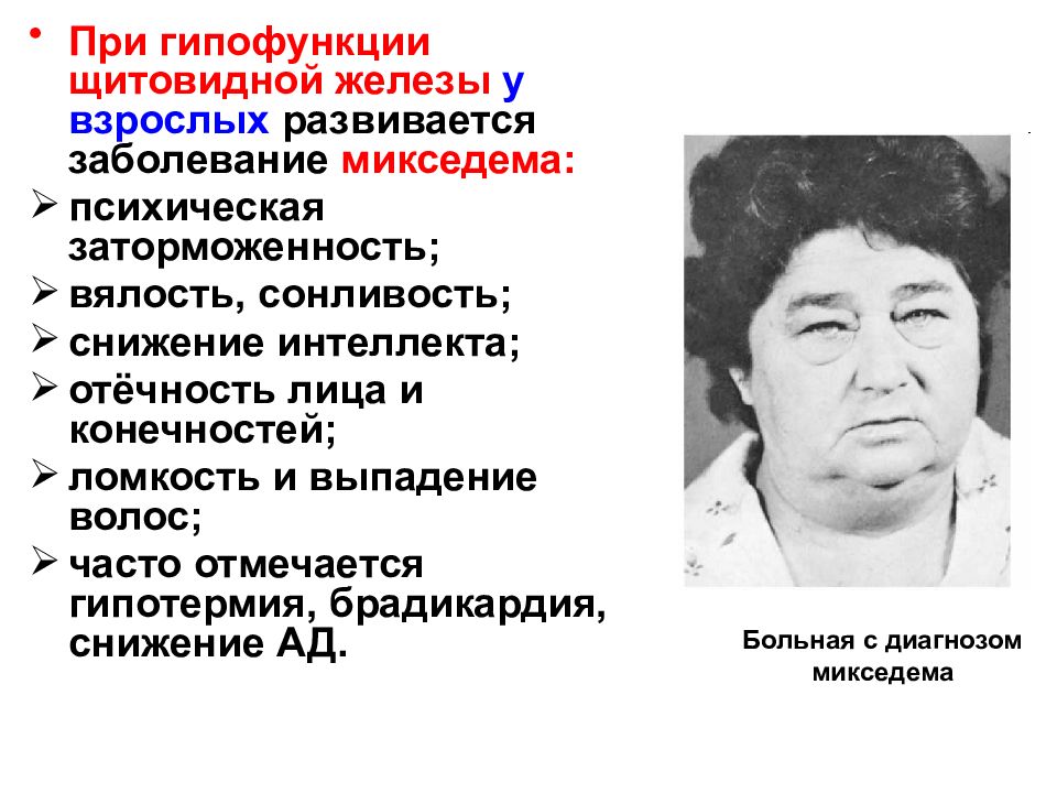 Гипофункция железы. При гипофункции щитовидной железы. Микседема щитовидной железы.