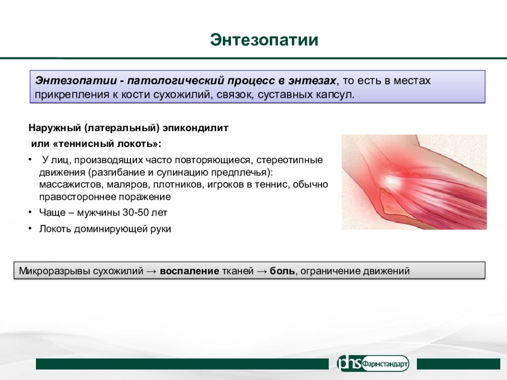 Энтезопатия что это такое. Энтезопатия сухожилия. Энтезопатии ахиллова сухожилия.