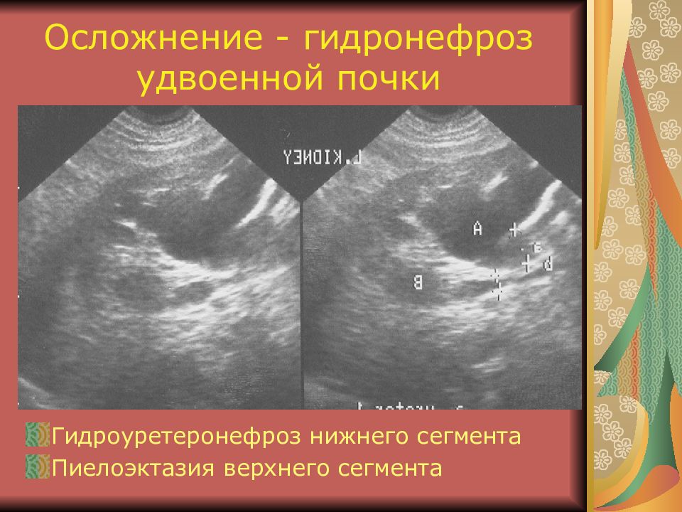 Что такое гидронефроз почки у взрослых. Гидронефроз правой почки УЗИ. Гидронефроз удвоенной почки. Гидронефроз сегмента удвоенной почки. Осложнение уретерогидронефроз.