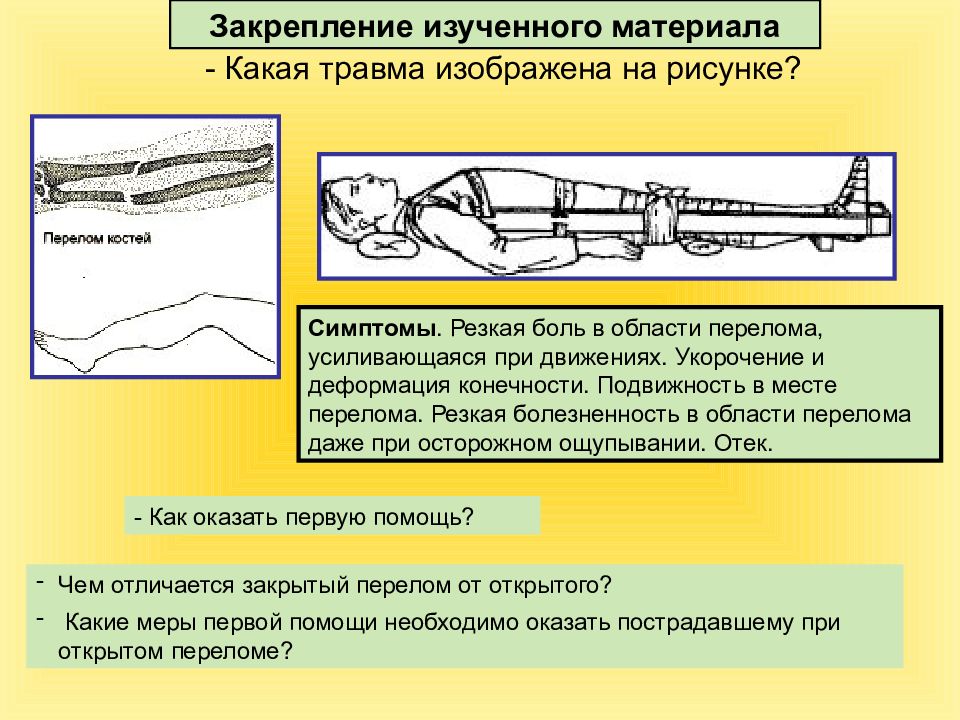 Первая помощь при растяжениях вывихах и переломах костей презентация