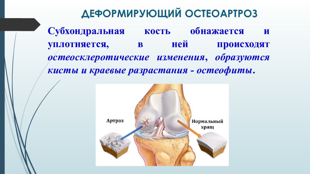 Диагноз доа суставов. Деформирующий остеоартроз. При деформирующем остеоартрозе. Деформирующий остеоартроз (доа). Проблемы пациента при деформирующем остеоартрозе.