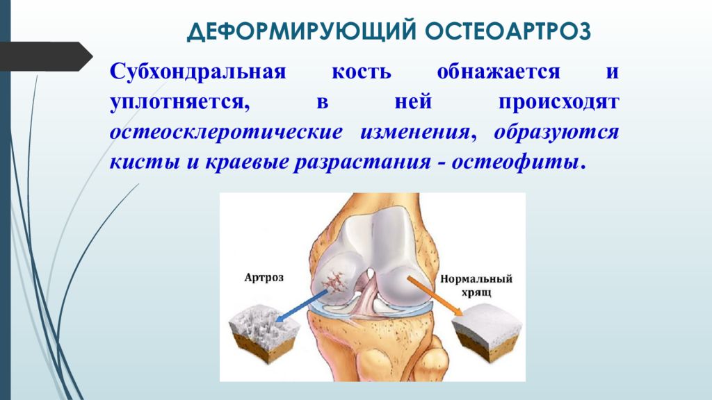 Деформирующий остеоартроз