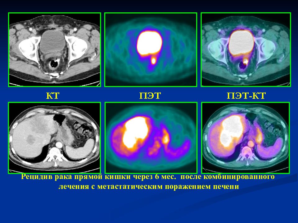 Пэт кт что это за исследование. ПЭТ кт изображение. Позитронная эмиссионная томография печени. ПЭТ кт презентация.