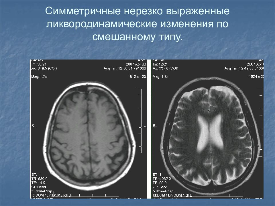 Мр картина наружной заместительной гидроцефалии головного мозга у взрослого что это