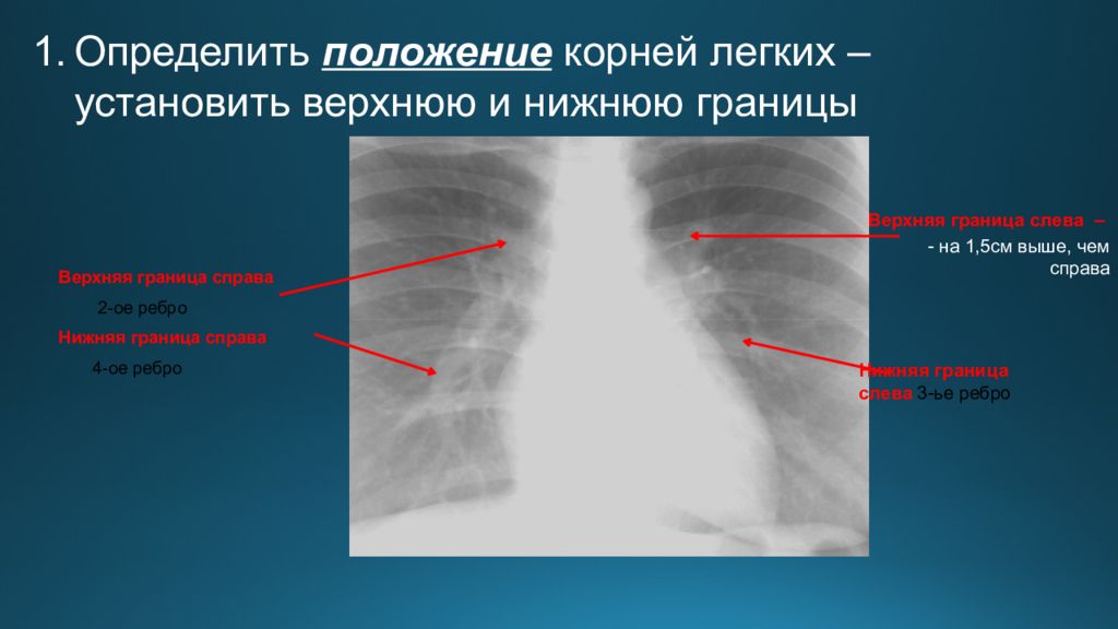 Верхняя справа. Тень корня легкого. Границы корней легких. Тень левого корня легкого. Лучевая диагностика корни легких.