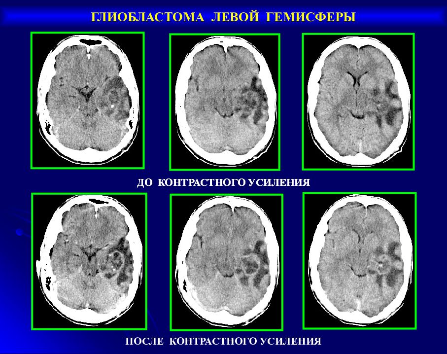 Гемисфер единичное. Глиобластома головного мозга на кт. Глиобластома головного мозга на кт и мрт.