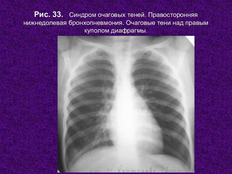 Бронхопневмония у детей. Правосторонняя нижнедолевая очаговая пневмония рентген. Правосторонняя бронхопневмония рентген. Очаговая бронхопневмония рентген. Нижнедолевая бронхопневмония пневмония.