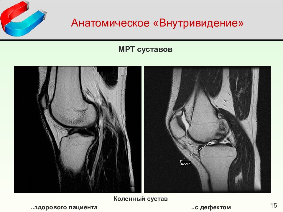 Мрт коленного сустава. Сумки коленного сустава мрт. Капсула коленного сустава мрт.