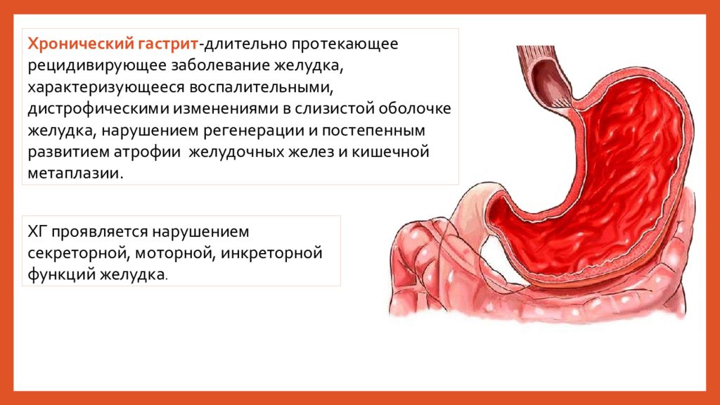 Острый и хронический гастрит презентация