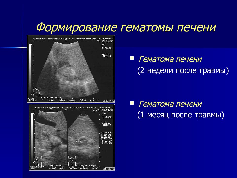 Ушиб печени. Подкапсульная гематома печени на УЗИ. Субкапсулярная гематома печени УЗИ. Признаки УЗИ гематомы печени.