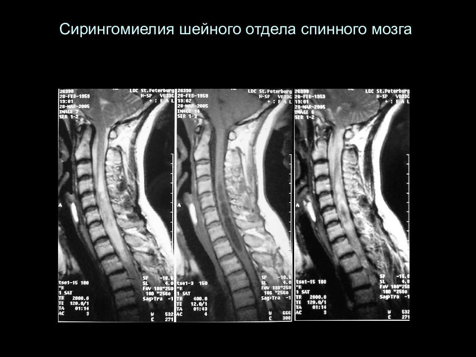 Гидромиелия шейного отдела